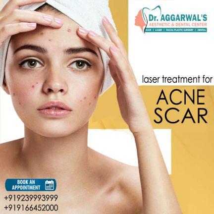 acne_compressed Laser Treatment for ACNE & ACNE SCARS