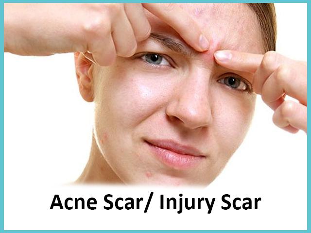3 Acne Scar /Injury Scar