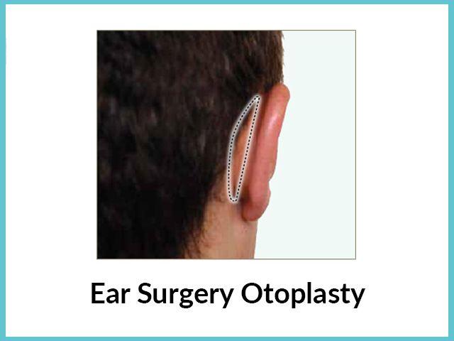 Ear surgery-otoplasty Ear surgery-otoplasty