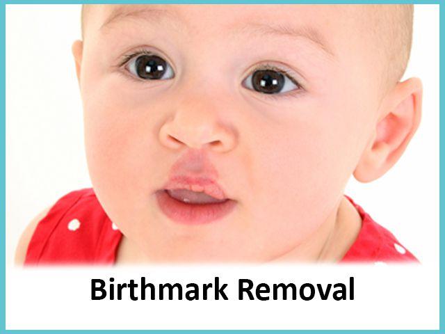 birthmark_removal birthmark_removal