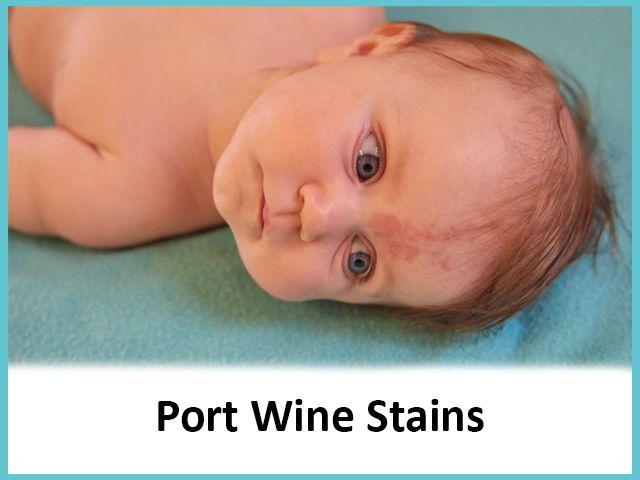 port wine stains port wine stains