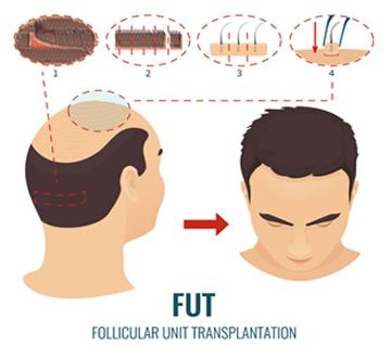 FUT-vs-FUE-Hair-Transplant-1 copy FUT-vs-FUE-Hair-Transplant-1 copy