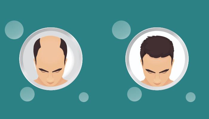 Know-the-Science-behind-Hair-Transplant Know-the-Science-behind-Hair-Transplant