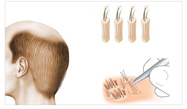 fue-follicle-unit-extraction-technique-dr-andre-nel fue-follicle-unit-extraction-technique-dr-andre-nel