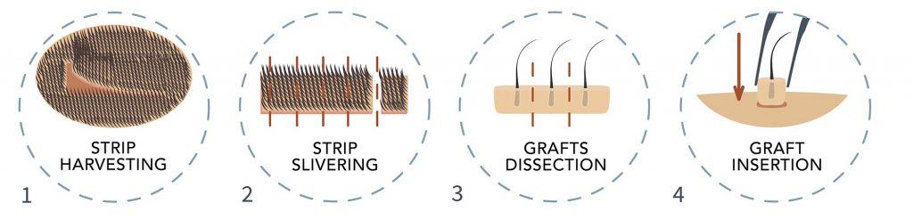 fut-hair-transplant-horiz-2000-1024x247 fut-hair-transplant-horiz-2000-1024x247