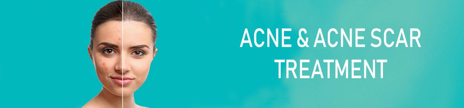 ACNE-AND-ACNE-SCAR-1536x360 copy