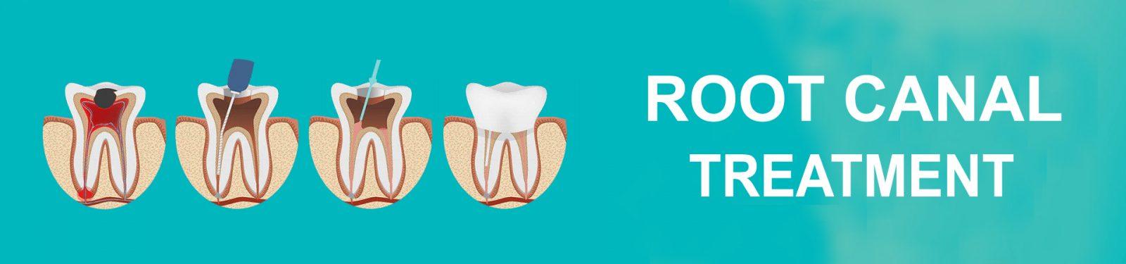 ROOT CANAL copy