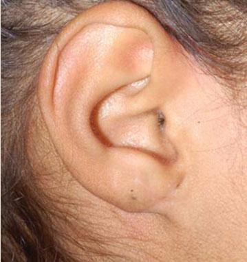 Earlobe Treatment in Jodhpur - Dr Aggarwals Clinic