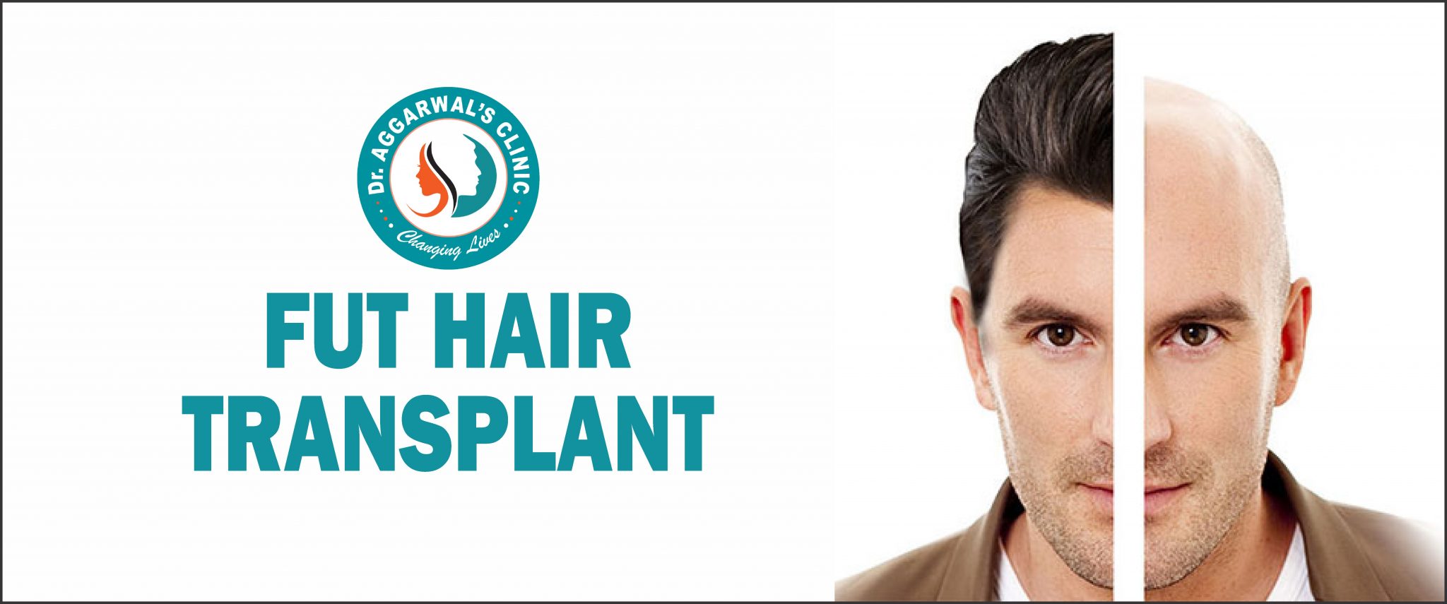 FUT Hair Transplant in Jodhpur DrAggarwalsClinic