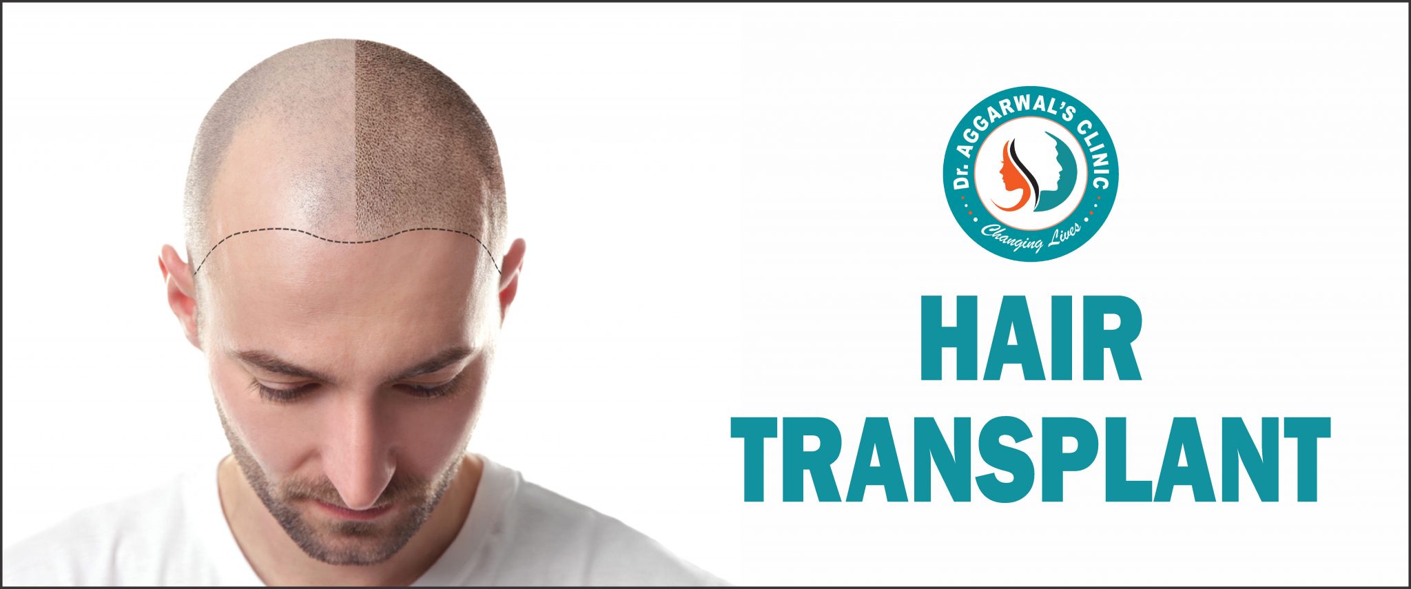 Hair Transplant Techniques DrAggarwalsClinic