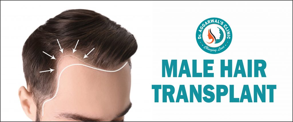 male hair transplant