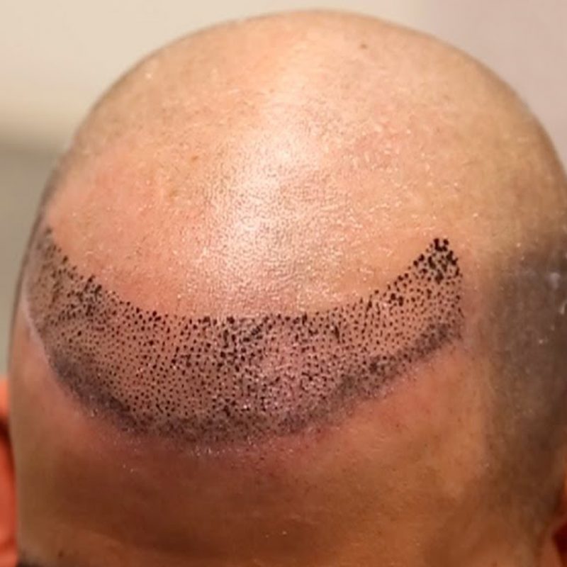Hair Transplant in Jodhpur DrAggarwalsClinic