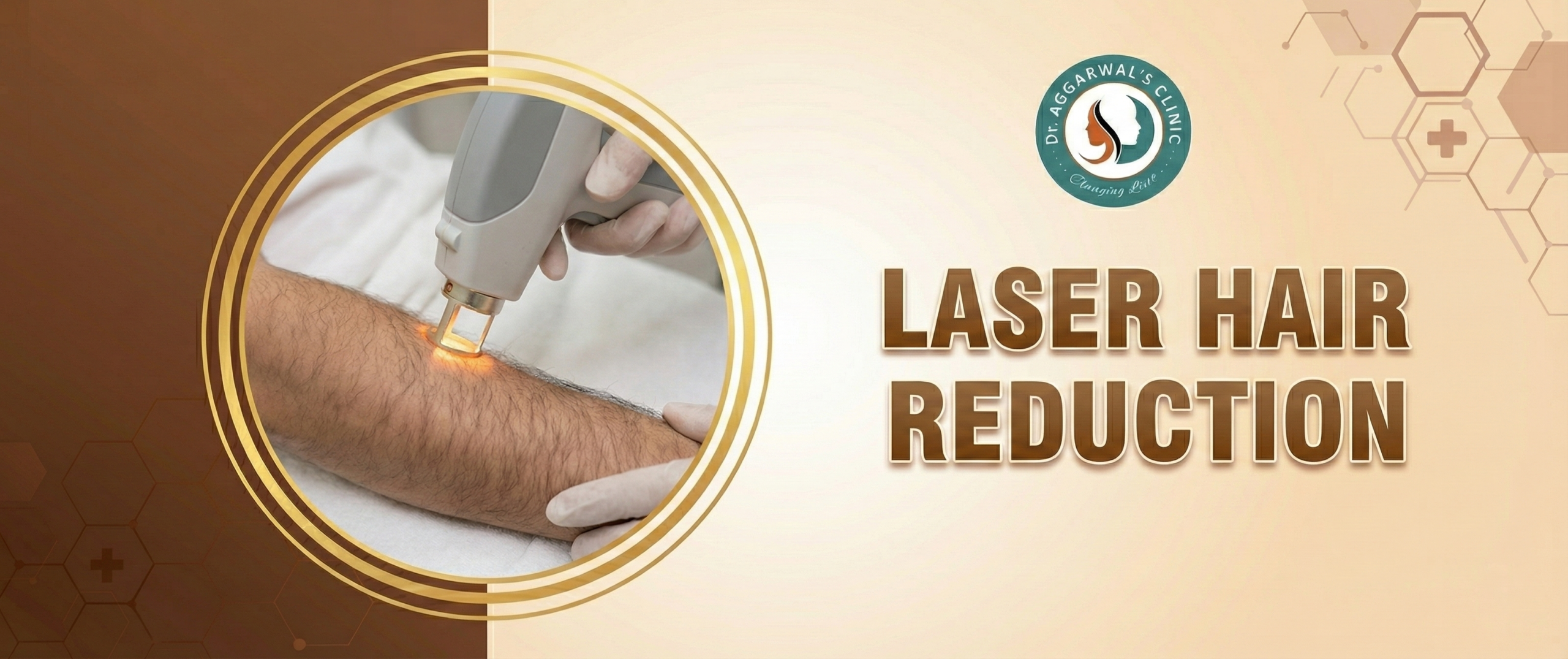 laser hair reduction