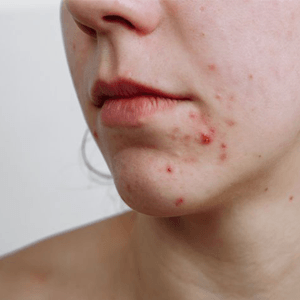skinqure.in263Laser-for-acne